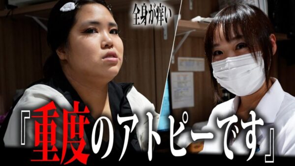 歌舞伎町ホームレス・まなみ、医者も驚く超重症のアトピーだった。痛々しすぎる引っ掻き跡に、視聴者も「辛いよね」と同情